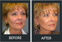 Ver cientos de fotos de antes y después de pacientes reales