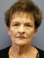 Facelift