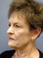 Facelift
