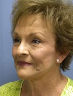 Facelift