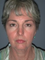 Facelift