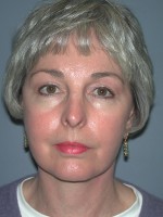 Facelift