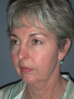 Facelift
