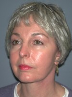 Facelift