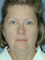 Facelift