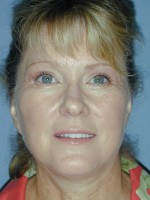 Facelift