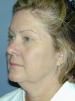 Facelift