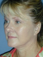 Facelift