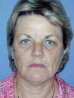 Facelift