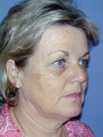 Facelift