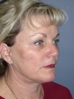 Facelift