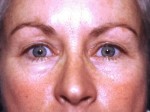 Facelift