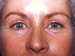 Facelift