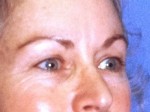 Facelift