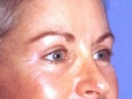 Facelift