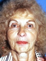 Facelift