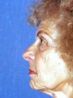 Facelift
