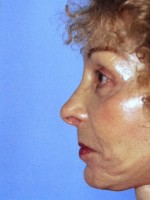 Facelift