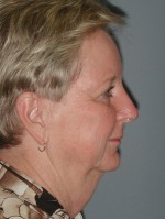 Facelift