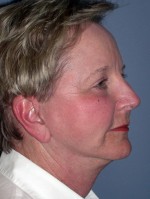 Facelift