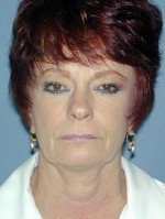 Facelift