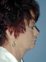Facelift