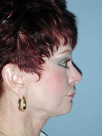 Facelift