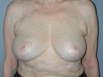 Breast Reduction