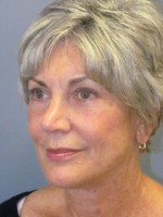 Blepharoplasty