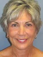 Blepharoplasty