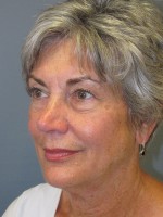 Blepharoplasty