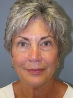 Blepharoplasty