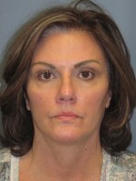 Blepharoplasty