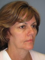 Blepharoplasty