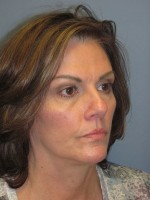 Blepharoplasty