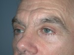 Blepharoplasty
