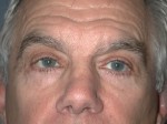 Blepharoplasty