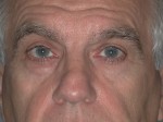 Blepharoplasty
