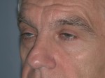 Blepharoplasty