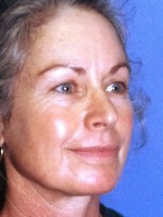 Blepharoplasty
