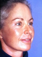 Blepharoplasty