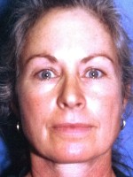 Blepharoplasty